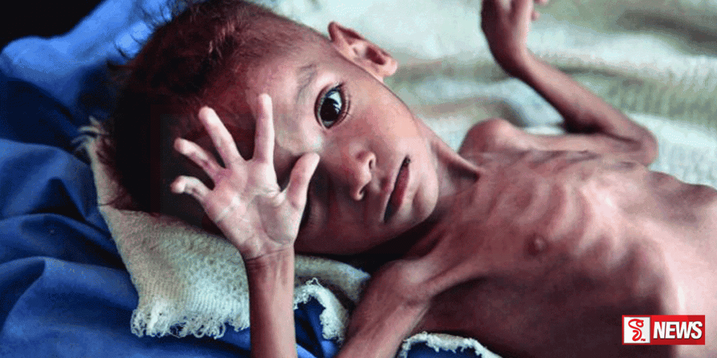 යේමන රජයේ පාලන ප්රදේශවල උග්ර මන්දපෝෂණය වැඩිවෙමින් පවති