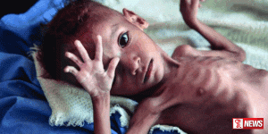 යේමන රජයේ පාලන ප්රදේශවල උග්ර මන්දපෝෂණය වැඩිවෙමින් පවති