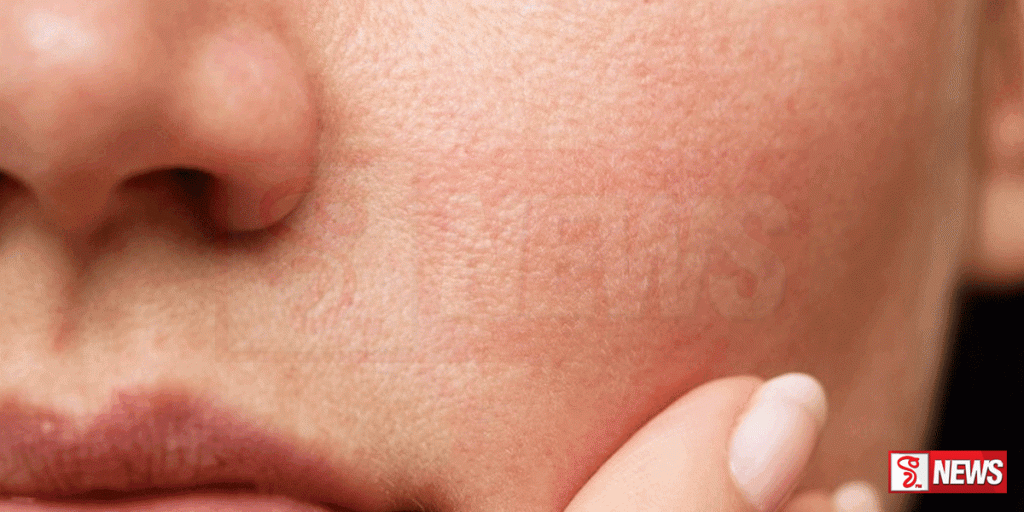 සමේ පිළිකා ඇතිවීමේ ප්රවණතාව ඉහළට