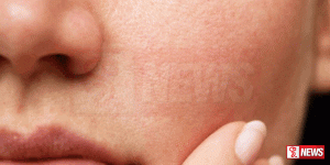 සමේ පිළිකා ඇතිවීමේ ප්රවණතාව ඉහළට