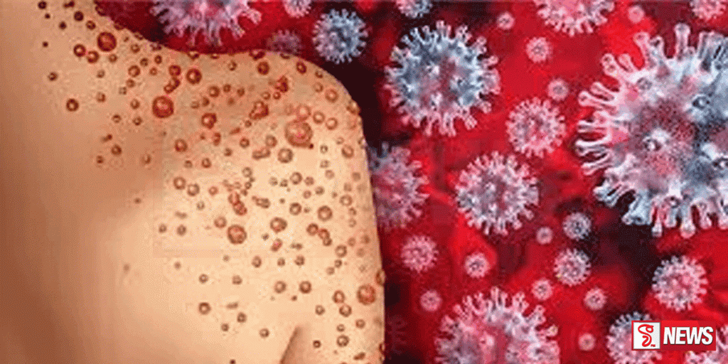 ලංකාවෙන් මන්කි ෆොක්ස් වැළදී ඇති දෙදෙනෙකු හමුවෙයි