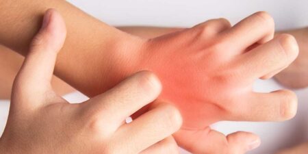 අනුරාධපුරය පුරා චර්ම රෝගයක්