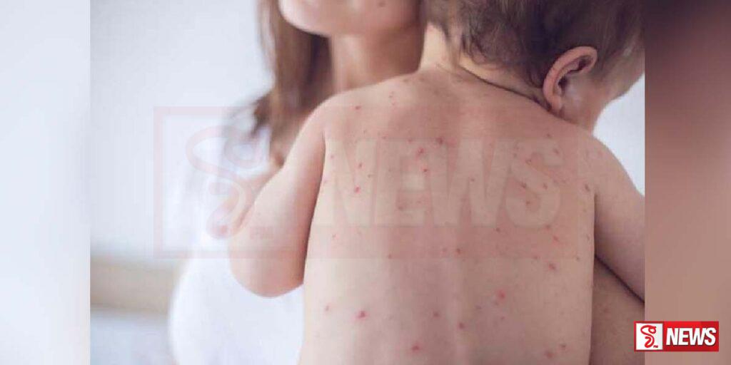 සරම්ප වැළඳුණු දරුවන් වාර්තා වීම ඉහළට