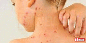 සරම්ප රෝගය වැළඳුණු ළමයින්ගේ ඉහළ යාමක්