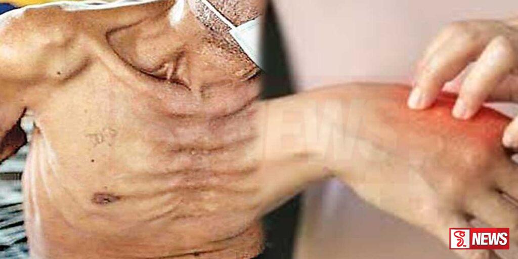 ලාදුරු සහ ක්ෂය රෝගීන් වැඩිම කොළඹ දිස්ත්රික්කයෙන්