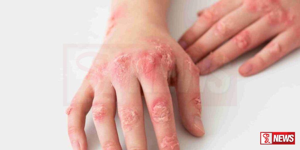 ලෝක එග්සිමා දිනය නොහොත් චර්ම ප්රදාහය දිනය අද