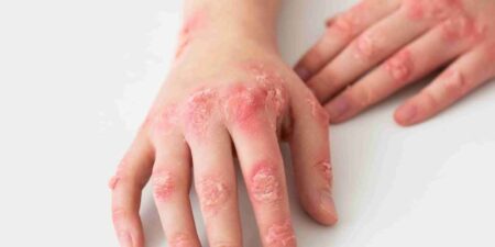 ලෝක එග්සිමා දිනය නොහොත් චර්ම ප්රදාහය දිනය අද