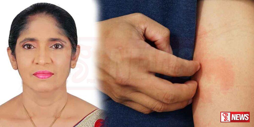 දරුවන් අතර විශේෂ චර්ම රෝගයක් පැතිර යන්නෙ නෑ