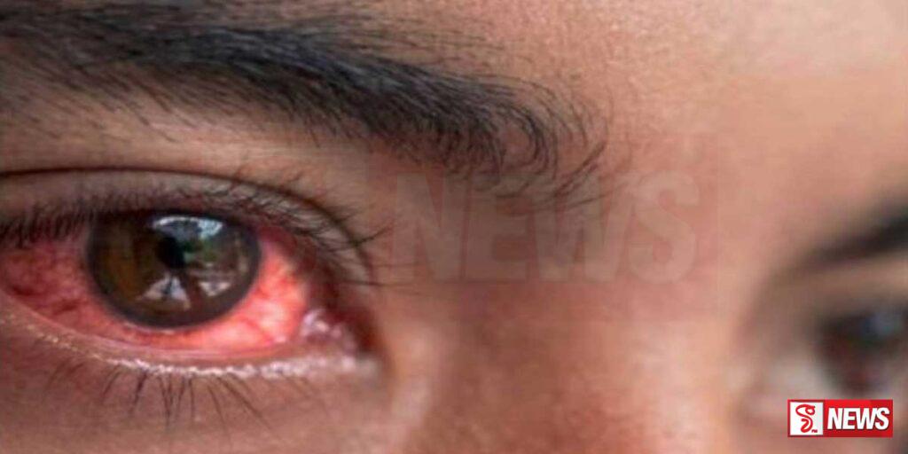 යාපනයේ පැතිරෙන ඇස් රෝගය