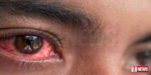 යාපනයේ පැතිරෙන ඇස් රෝගය