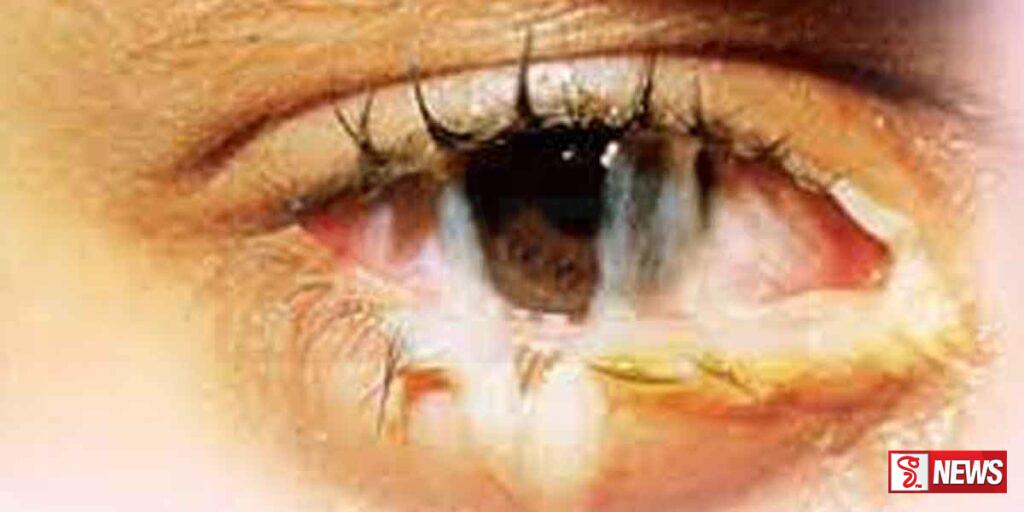 පාසල් ළමුන් අතර පැතිරි යන ඇස් රෝගයක්