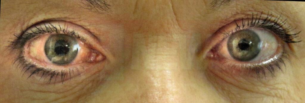 ග්ලුකෝමාවලින් තොර ලෝකයක් සදහා එක්වෙමු