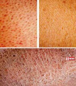 උණුසුමෙන් චර්ම රෝග අවදානම ඉහළට