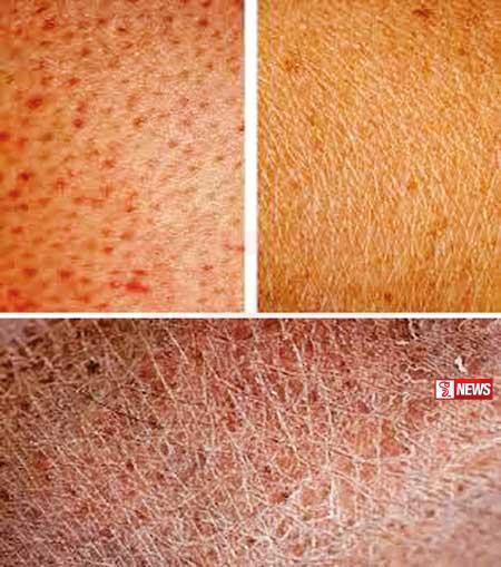 උණුසුමෙන් චර්ම රෝග අවදානම ඉහළට