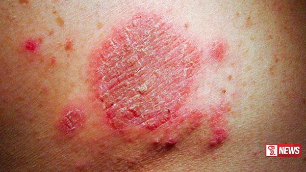 උණුසුම් කාලගුණ තත්වයත් සමඟ -චර්ම රෝග ඉහළට