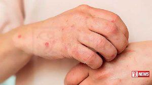 අනුරාධපුර දිස්ත්රික්කයේ ටීනියා රෝගය ව්යාප්ත වීමේ අවදානමක්