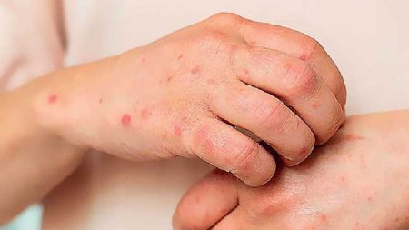 අනුරාධපුර දිස්ත්රික්කයේ ටීනියා රෝගය ව්යාප්ත වීමේ අවදානමක්