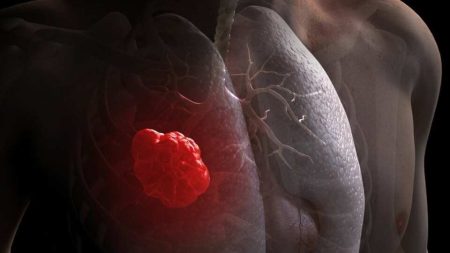 කාන්තාවන් අතර පෙනහළු පිළිකා වාර්තා වීම ඉහළට