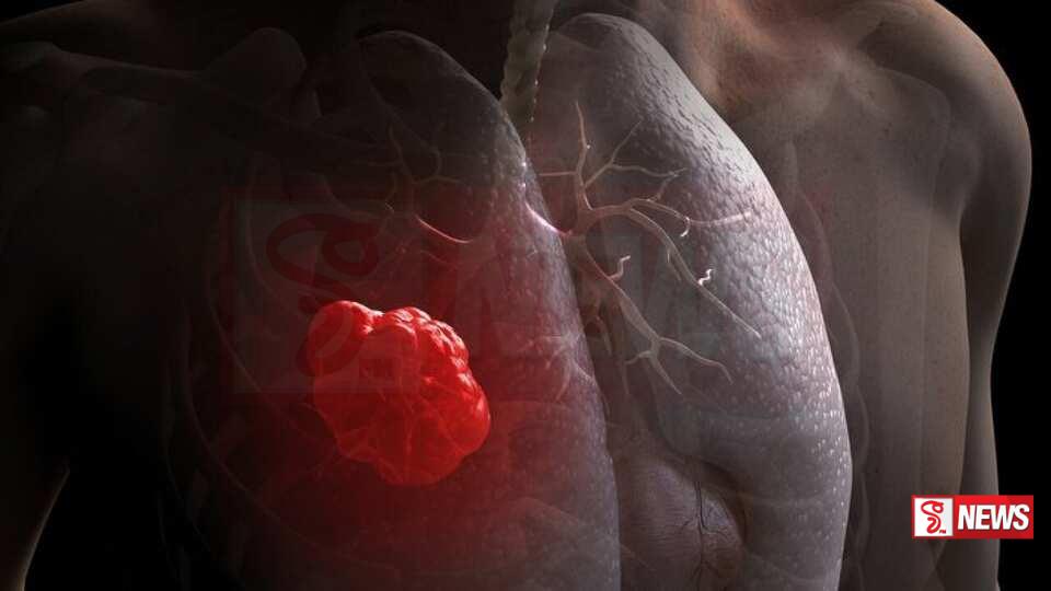 කාන්තාවන් අතර පෙනහළු පිළිකා වාර්තා වීම ඉහළට