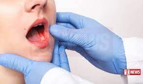 පාසල් දරුවන්ට මුඛ පිළිකා අවදානමක්