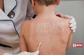 අමෙරිකාවේ ප්රදේශ රැසක සරම්ප පැතිරීම ඉහළට