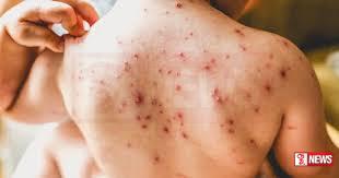 එක්සත් ජනපදයේ සරම්ප රෝගීන් ඉහළට