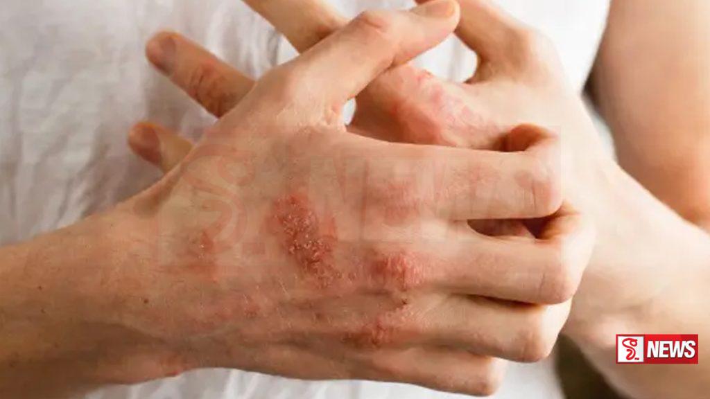 චර්ම රෝග බරපතළ සෞඛ්ය ගැටලුවක් – වෛද්යවරු අනතුරු අඟවයි