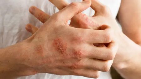 චර්ම රෝග බරපතළ සෞඛ්ය ගැටලුවක් – වෛද්යවරු අනතුරු අඟවයි